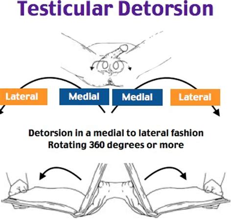 open book test for testicular torsion|high riding testis torsion.